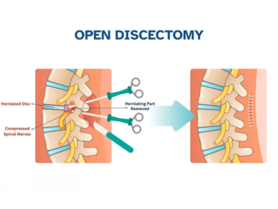 Discectomy Surgery - Mindspine