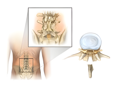 Laminectomy Surgery - Mindspine
