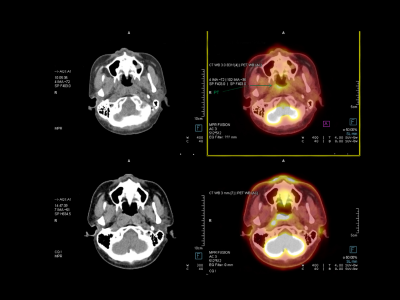 PET Scans - Mindspine